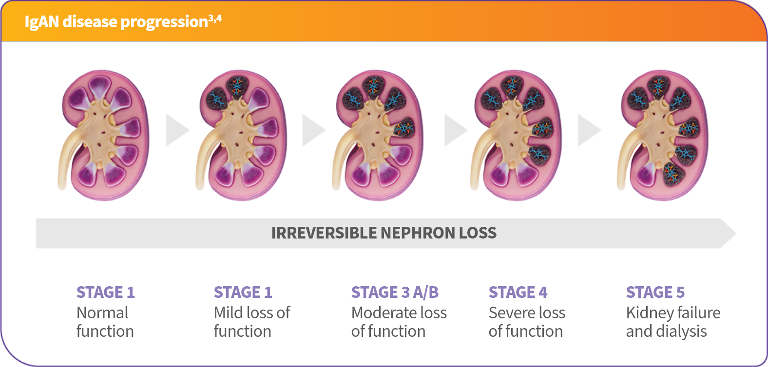 Chart with the five stages of igan disease progression with graphics of kidneys