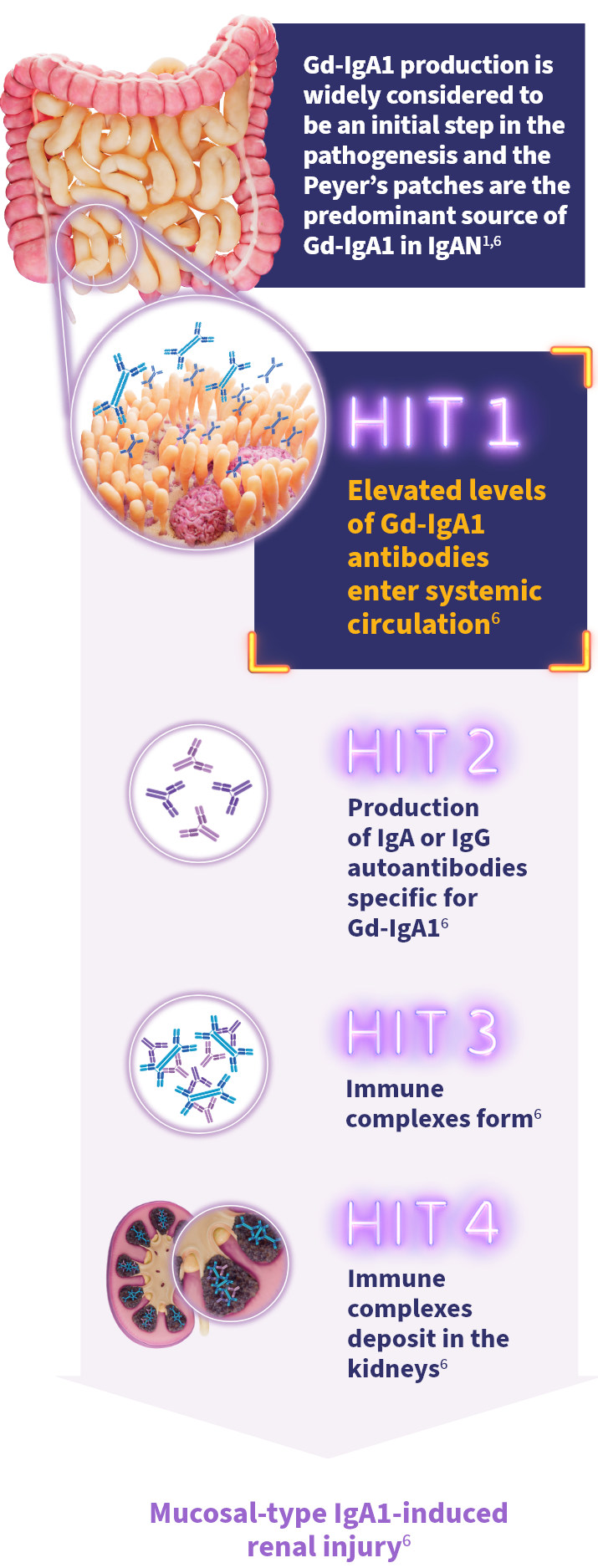 Diagram of the 4-HIT model explaining IgAN pathogenesis: Gd-IgA1 enters circulation, forms autoantibodies, creates immune complexes, and deposits in kidneys.