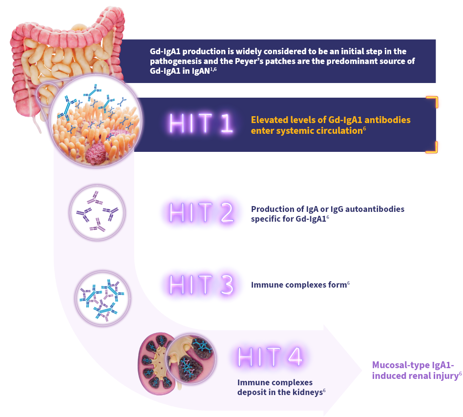 Diagram of the 4-HIT model explaining IgAN pathogenesis: Gd-IgA1 enters circulation, forms autoantibodies, creates immune complexes, and deposits in kidneys.