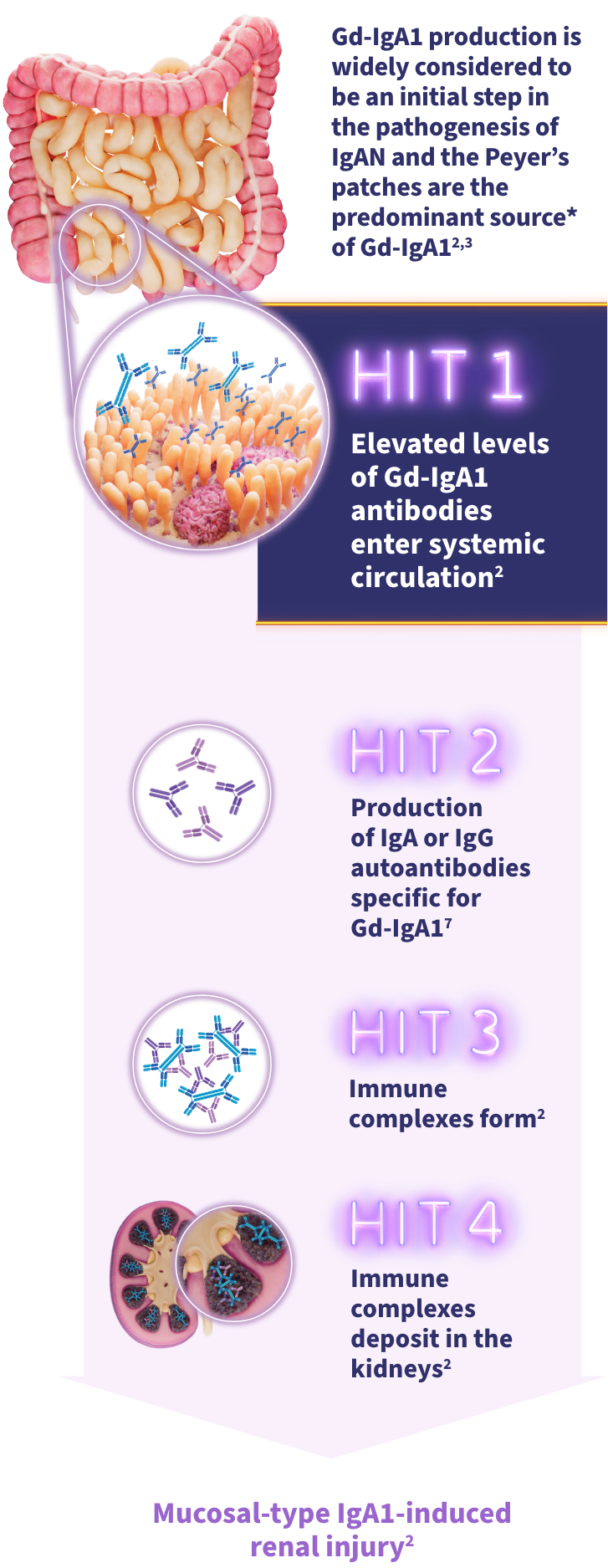 Diagram of the 4-HIT model explaining IgAN pathogenesis: Gd-IgA1 enters circulation, forms autoantibodies, creates immune complexes, and deposits in kidneys.