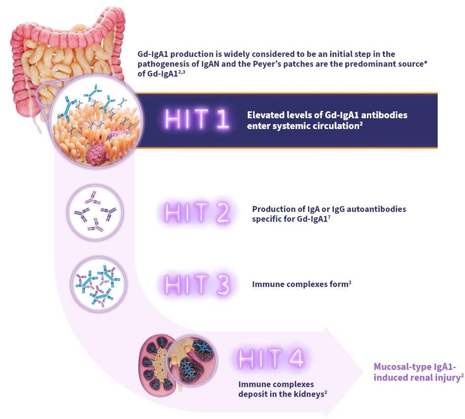 Diagram of the 4-HIT model explaining IgAN pathogenesis: Gd-IgA1 enters circulation, forms autoantibodies, creates immune complexes, and deposits in kidneys.